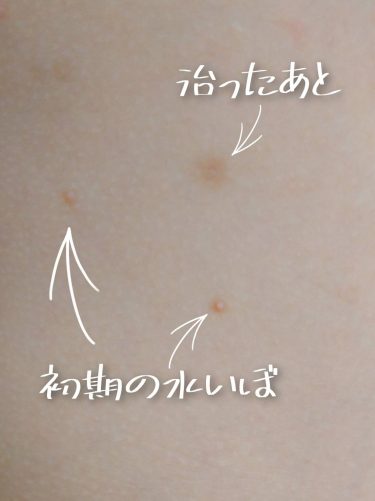 【わが家の水いぼとの闘い】全身への広がり＆やってしまった兄妹感染！水いぼは痛くないけど・・・