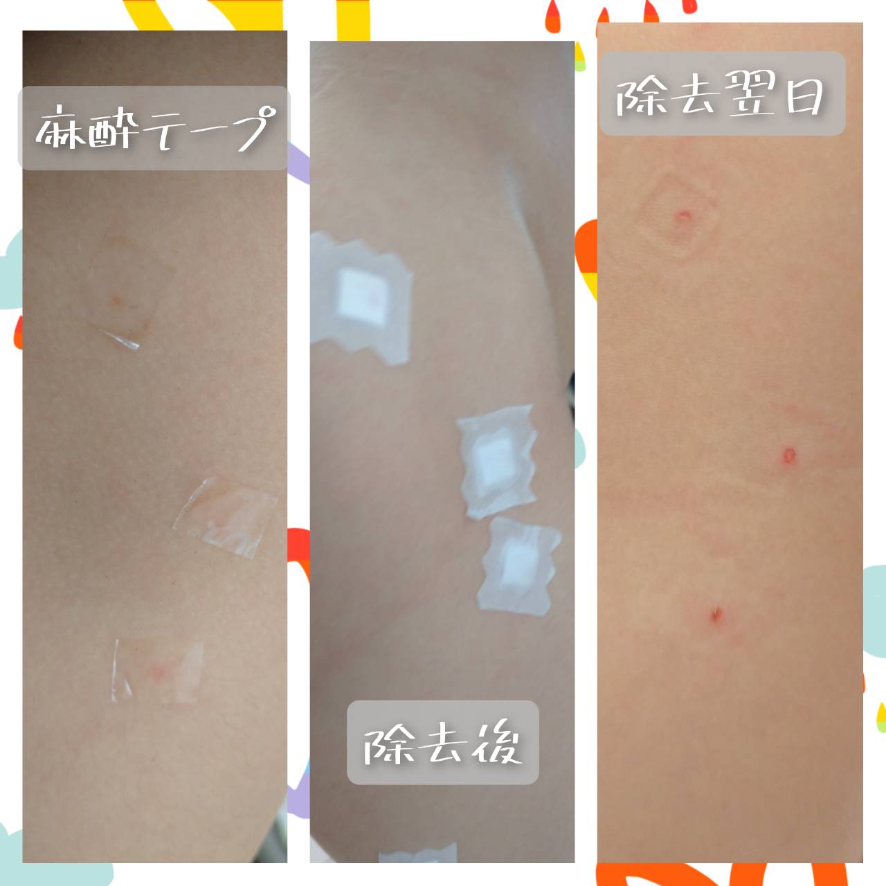 わが家の水いぼとの闘い 全身への広がり やってしまった兄妹感染 水いぼは痛くないけど