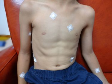 【わが家の水いぼとの闘い】小1息子の水いぼ除去